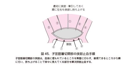 胎盤鉗|Q14．前置胎盤・低置胎盤で出血が多い際の対応は？